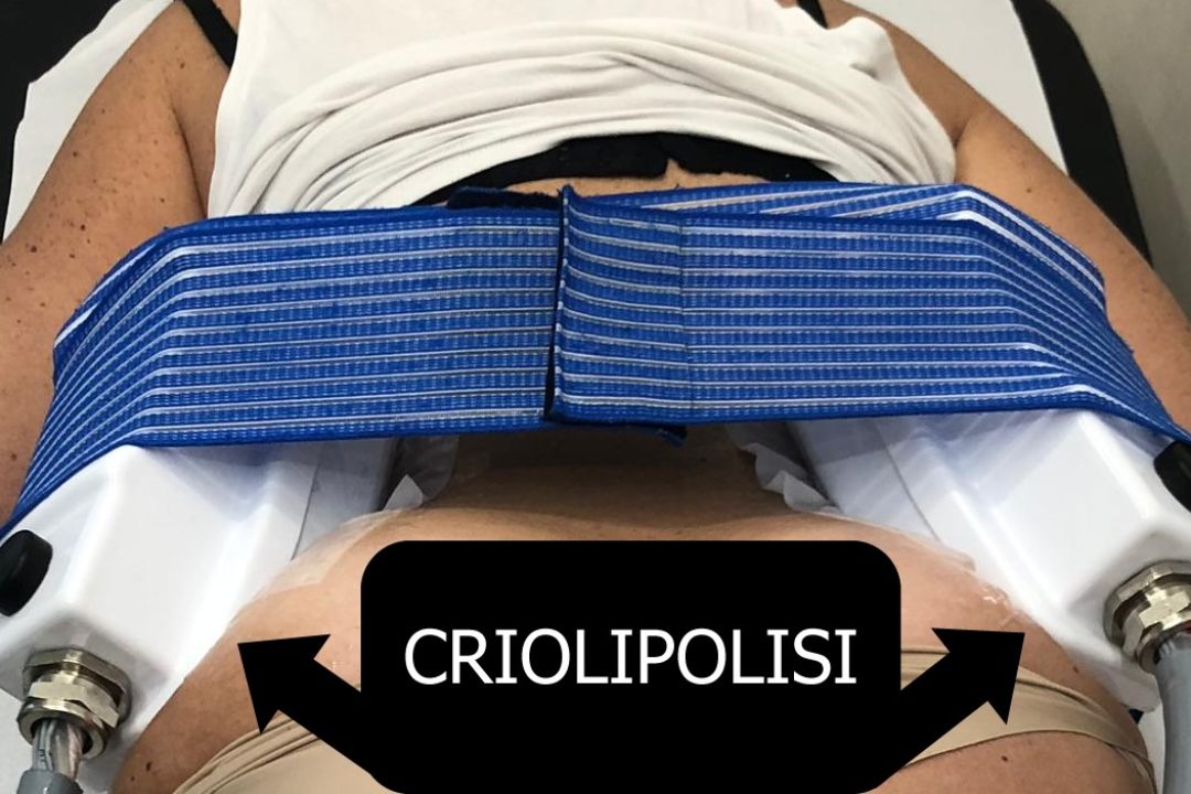 Criolipolisi per il trattamento delle adiposità localizzate