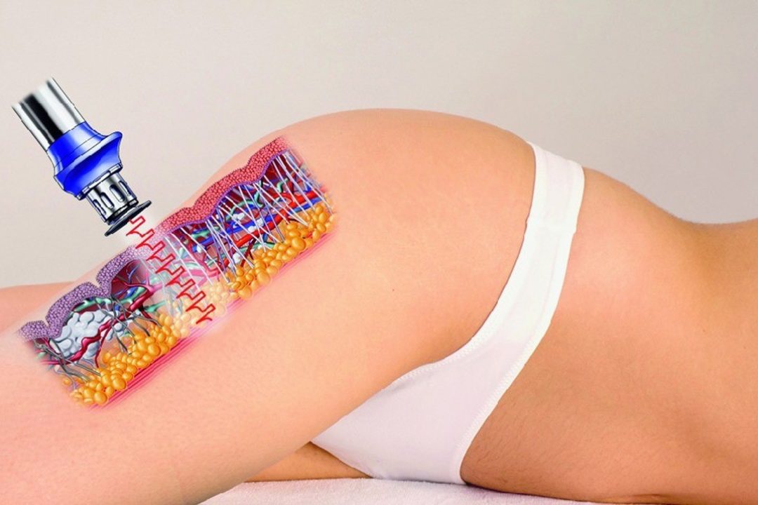 Onde d’Urto per il trattamento degli inestetismi della Cellulite